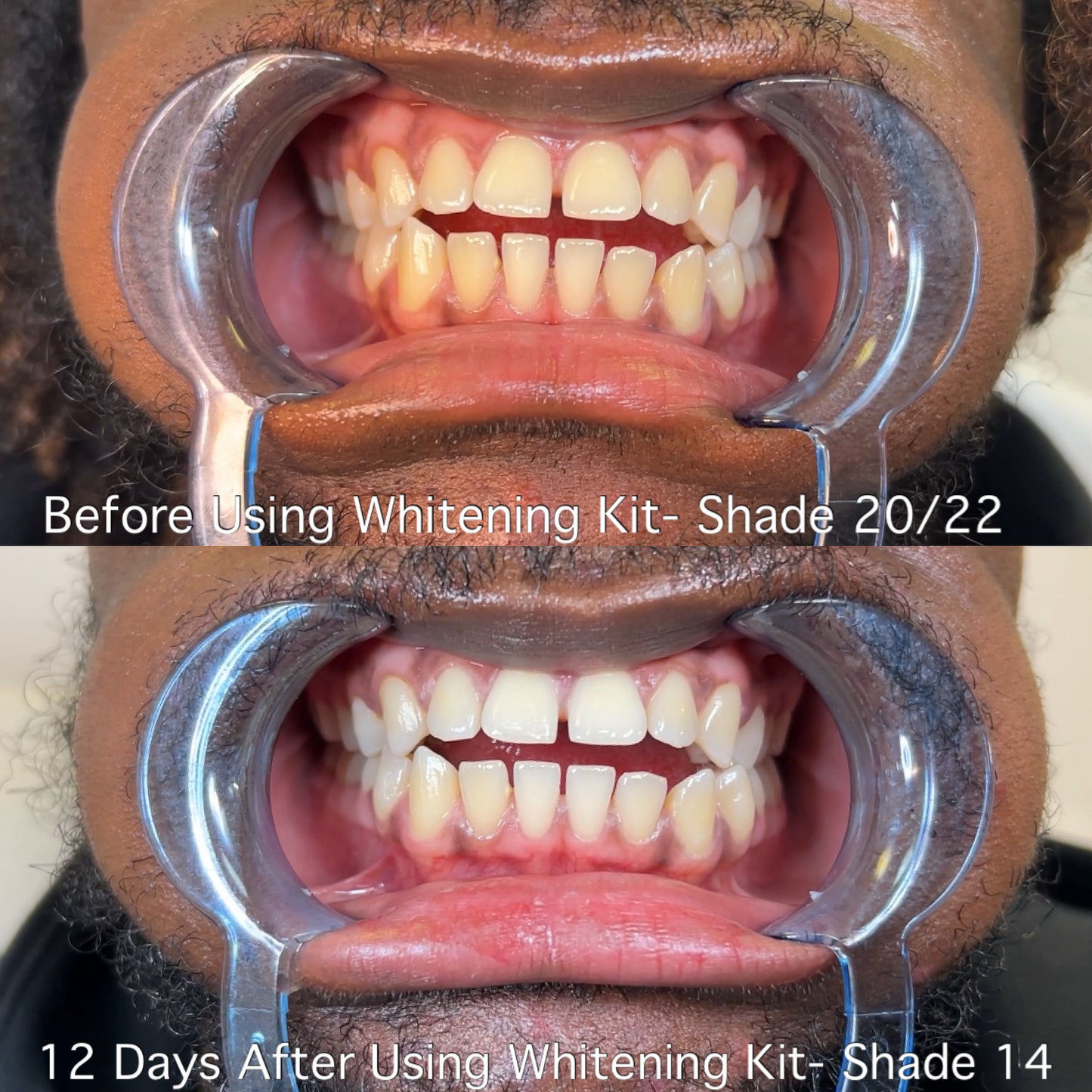 At Home Whitening Kit